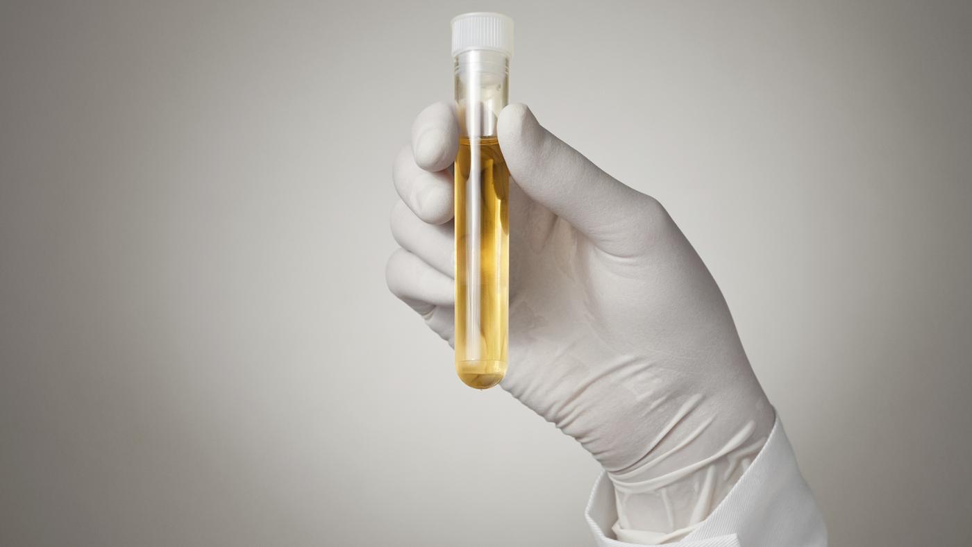 High Protein in Urine