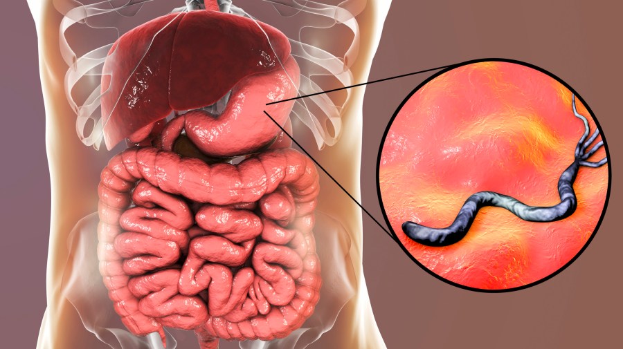 Gastritis ruidos intestinales