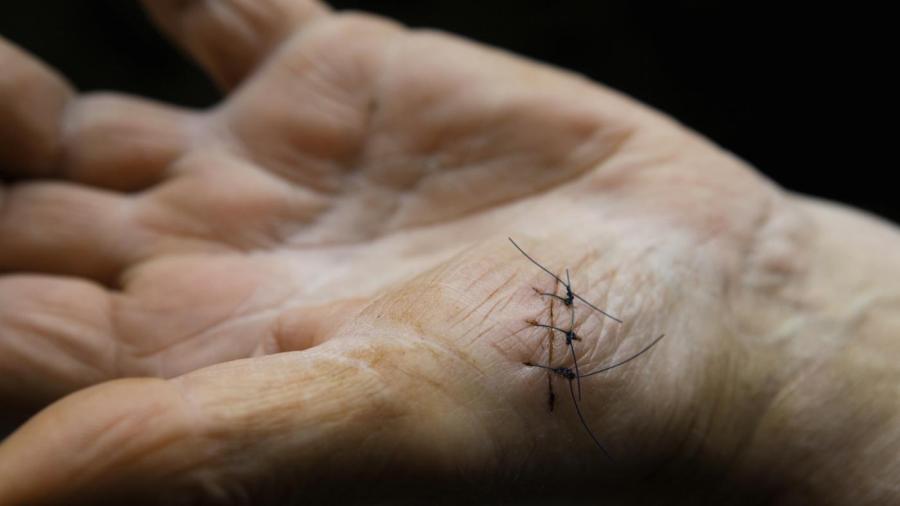 What Do Infected Stitches Look Like?