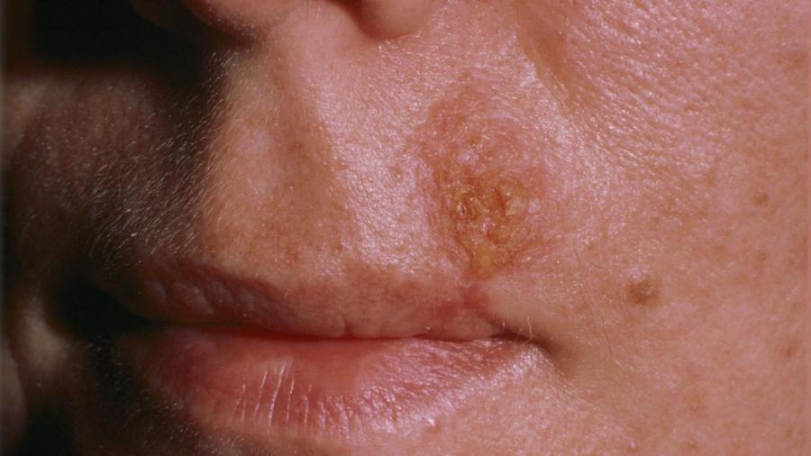 What Does Indian Fire Rash Look Like?